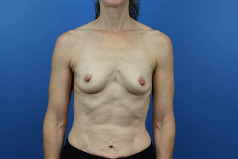 Before Image: Breast Augmentation - front