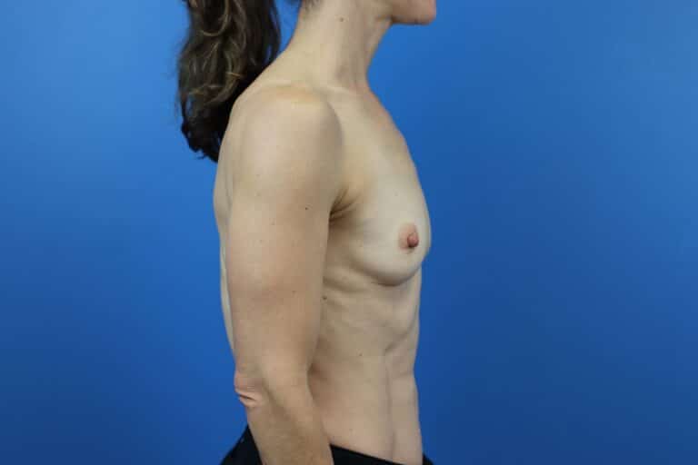 Before Image: Breast Augmentation - right-side