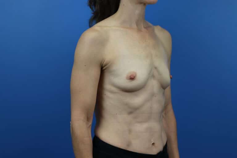 Before Image: Breast Augmentation - right-front-oblique