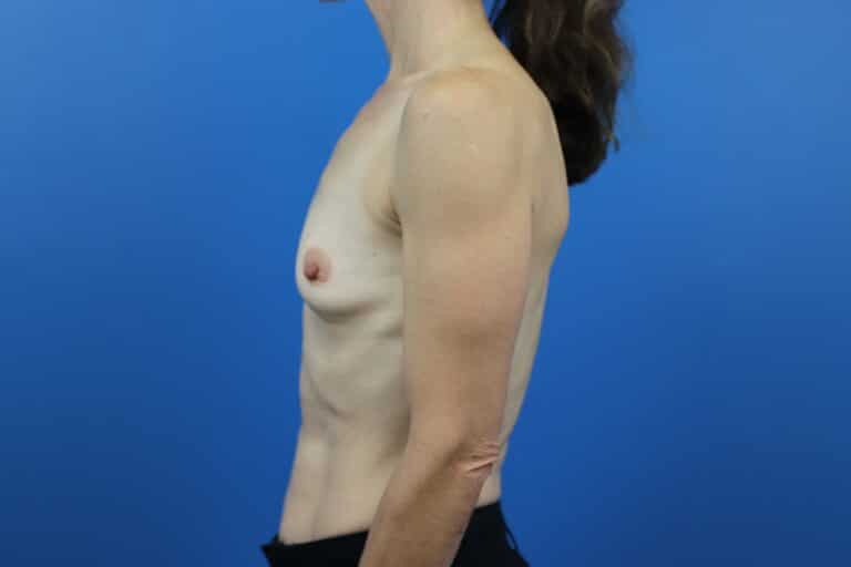Before Image: Breast Augmentation - left-side