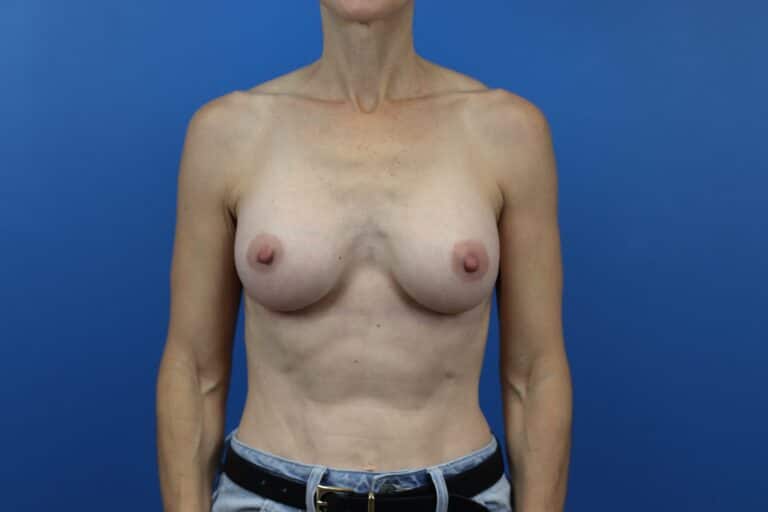 After Image: Breast Augmentation - front