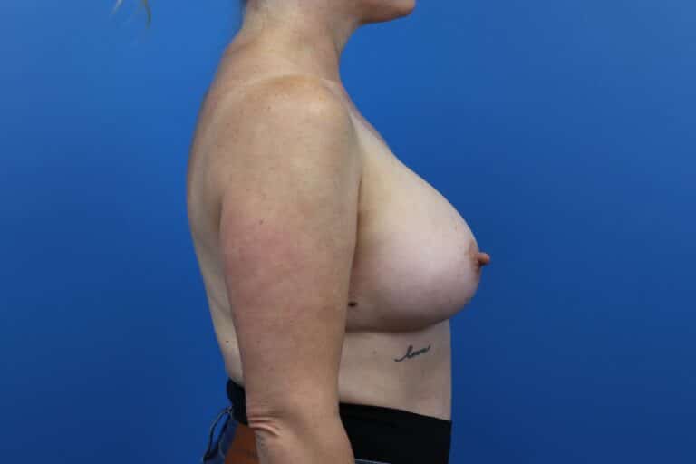 After Image: Breast Augmentation - right-side
