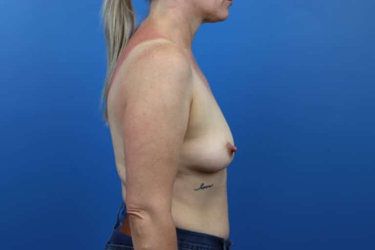 Before Image: Breast Augmentation - right-side