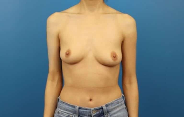 Before Image: Breast Augmentation - front