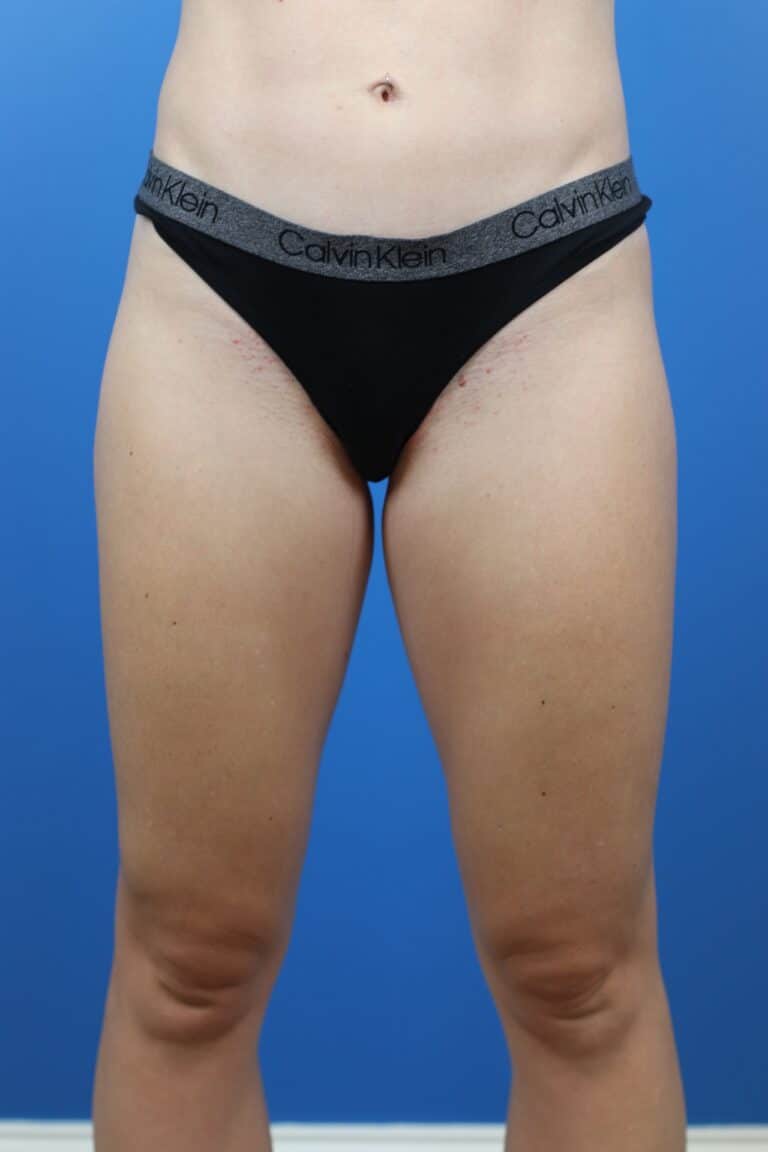 Before Image: Explantation with Autologous Fat Transfer to Breasts - front