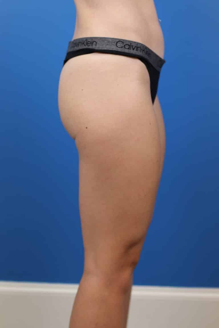 Before Image: Explantation with Autologous Fat Transfer to Breasts - right-side