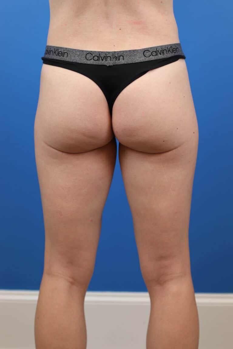 Before Image: Explantation with Autologous Fat Transfer to Breasts - back