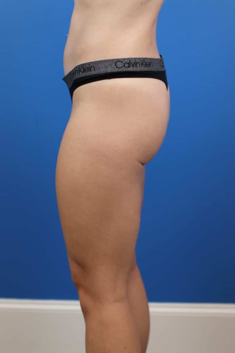 Before Image: Explantation with Autologous Fat Transfer to Breasts - left-side