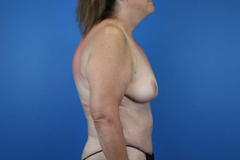 After Image: Abdominoplasty, Mastopexy - right-side