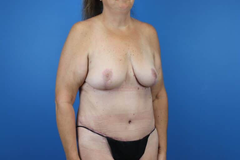 After Image: Abdominoplasty, Mastopexy - right-front-oblique