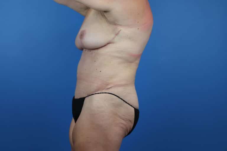 After Image: Abdominoplasty, Mastopexy - left-side