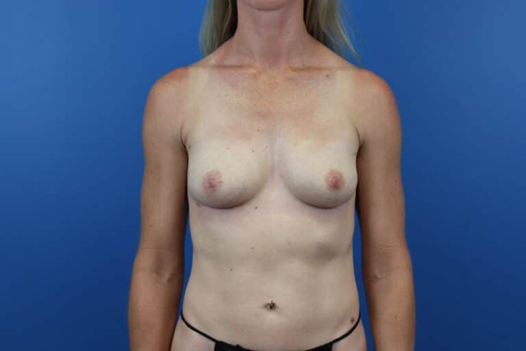 After Image: Explantation with Autologous Fat Transfer to Breasts - front