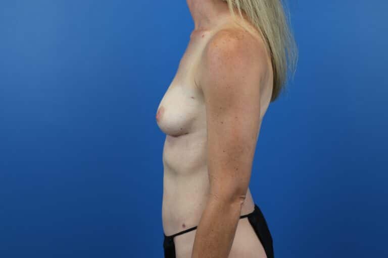 After Image: Explantation with Autologous Fat Transfer to Breasts - left-side