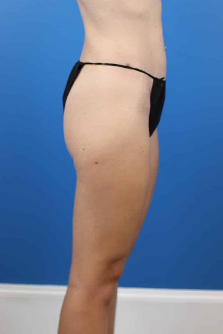 After Image: Explantation with Autologous Fat Transfer to Breasts - right-side