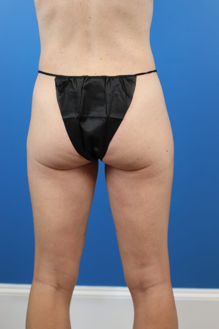 After Image: Explantation with Autologous Fat Transfer to Breasts - back