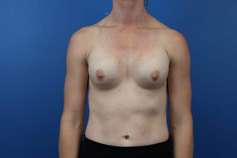 Before Image: Explantation with Autologous Fat Transfer to Breasts - front