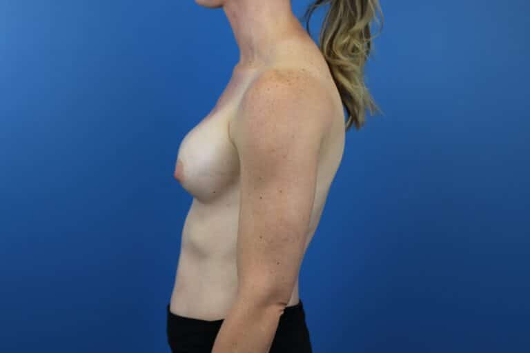 Before Image: Explantation with Autologous Fat Transfer to Breasts - left-side