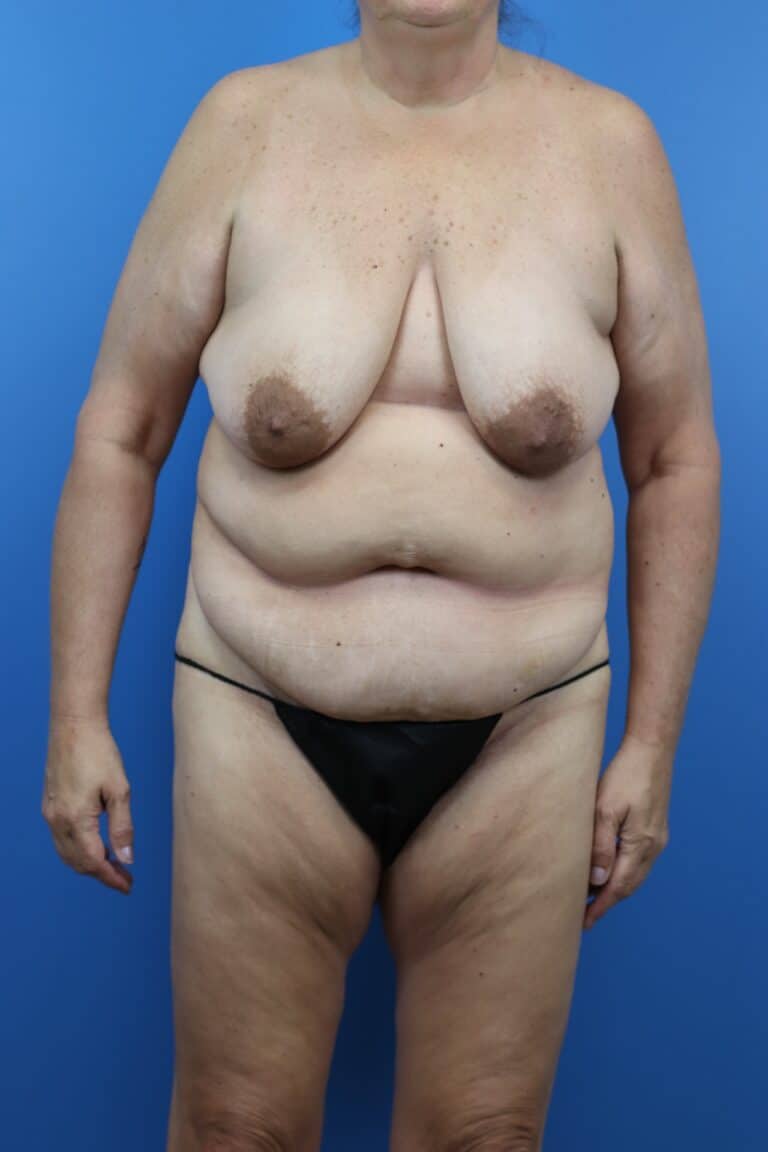Before Image: Abdominoplasty, Mastopexy - front