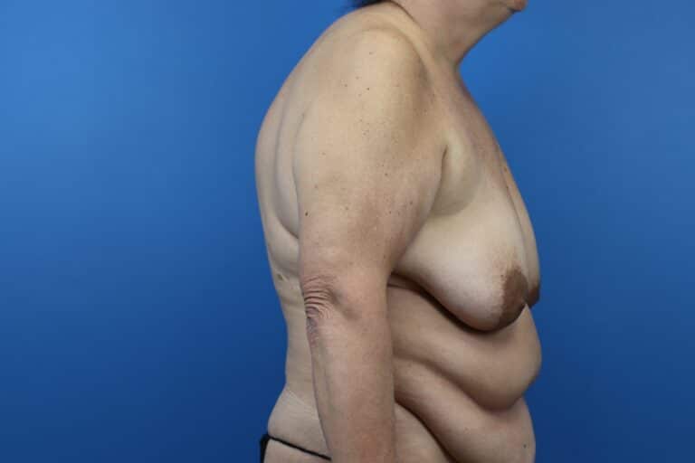 Before Image: Abdominoplasty, Mastopexy - right-side