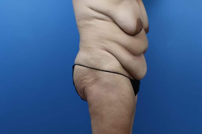 Before Image: Abdominoplasty, Mastopexy - right-side