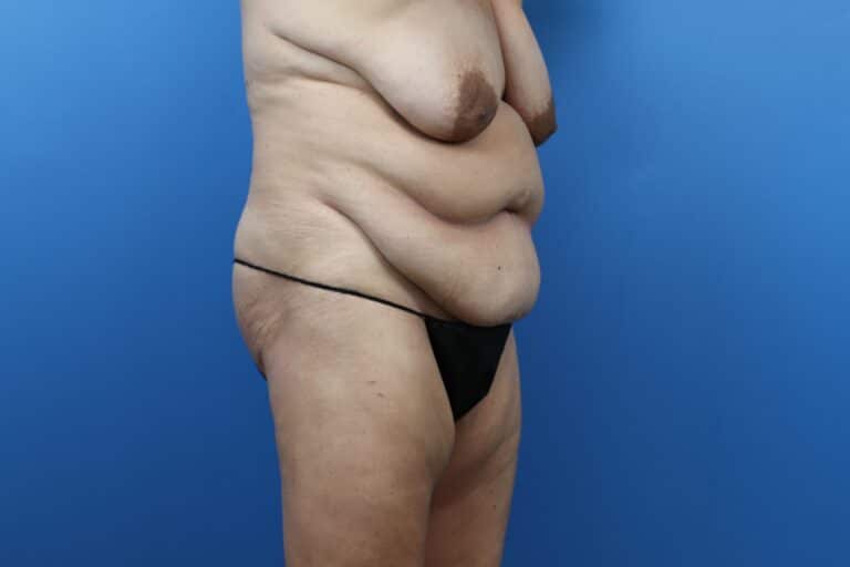Before Image: Abdominoplasty, Mastopexy - right-front-oblique