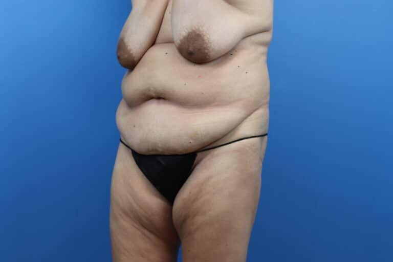 Before Image: Abdominoplasty, Mastopexy - left-front-oblique