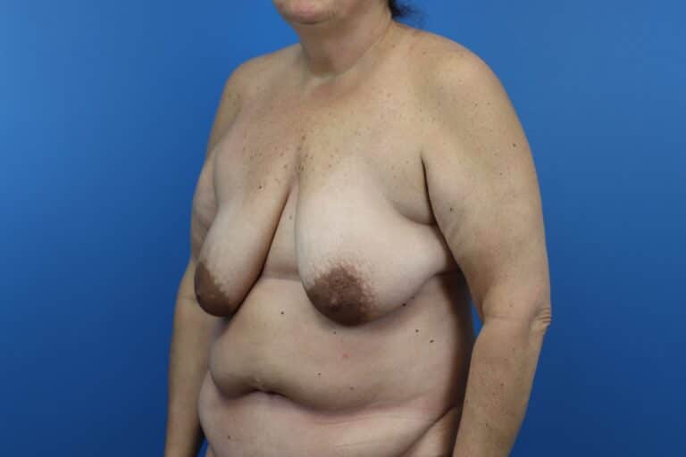 Before Image: Abdominoplasty, Mastopexy - left-front-oblique