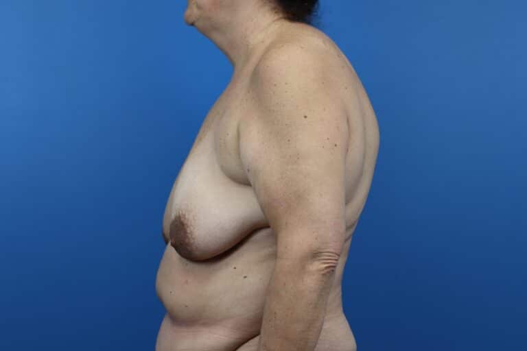Before Image: Abdominoplasty, Mastopexy - left-side