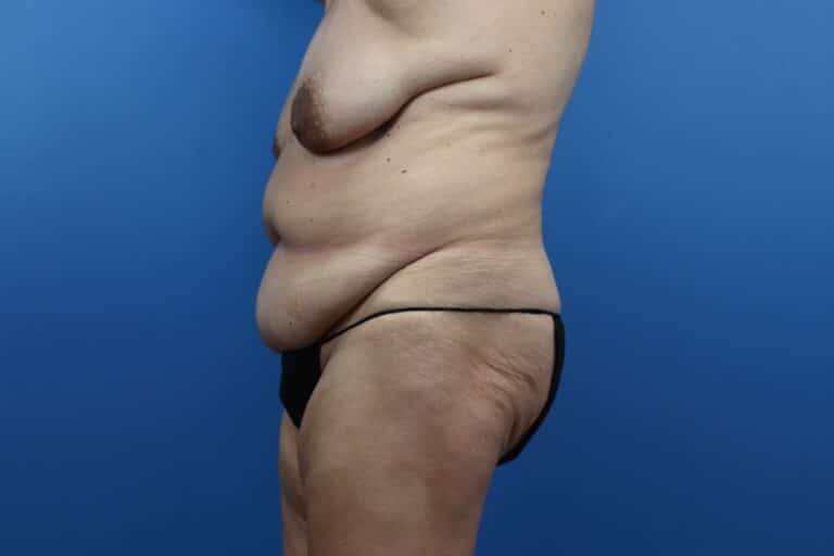 Before Image: Abdominoplasty, Mastopexy - left-side