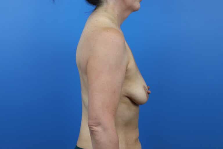Before Image: Breast Augmentation - right-side