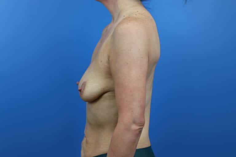 Before Image: Breast Augmentation - left-side