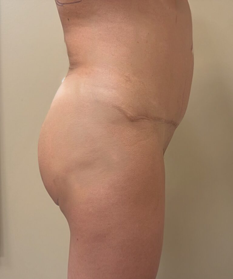 Before Image: Brazilian Buttock Lift - right-side