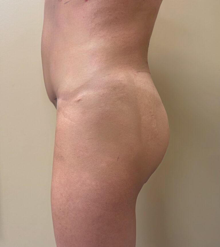 Before Image: Brazilian Buttock Lift - left-side