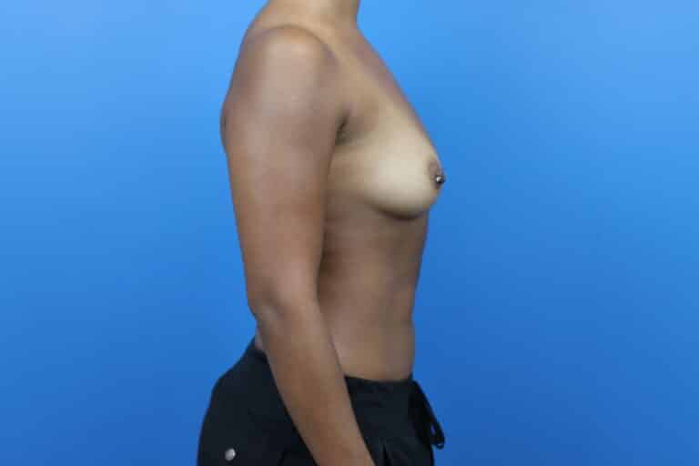 Before Image: Breast Augmentation with Silicone Implants - right-side