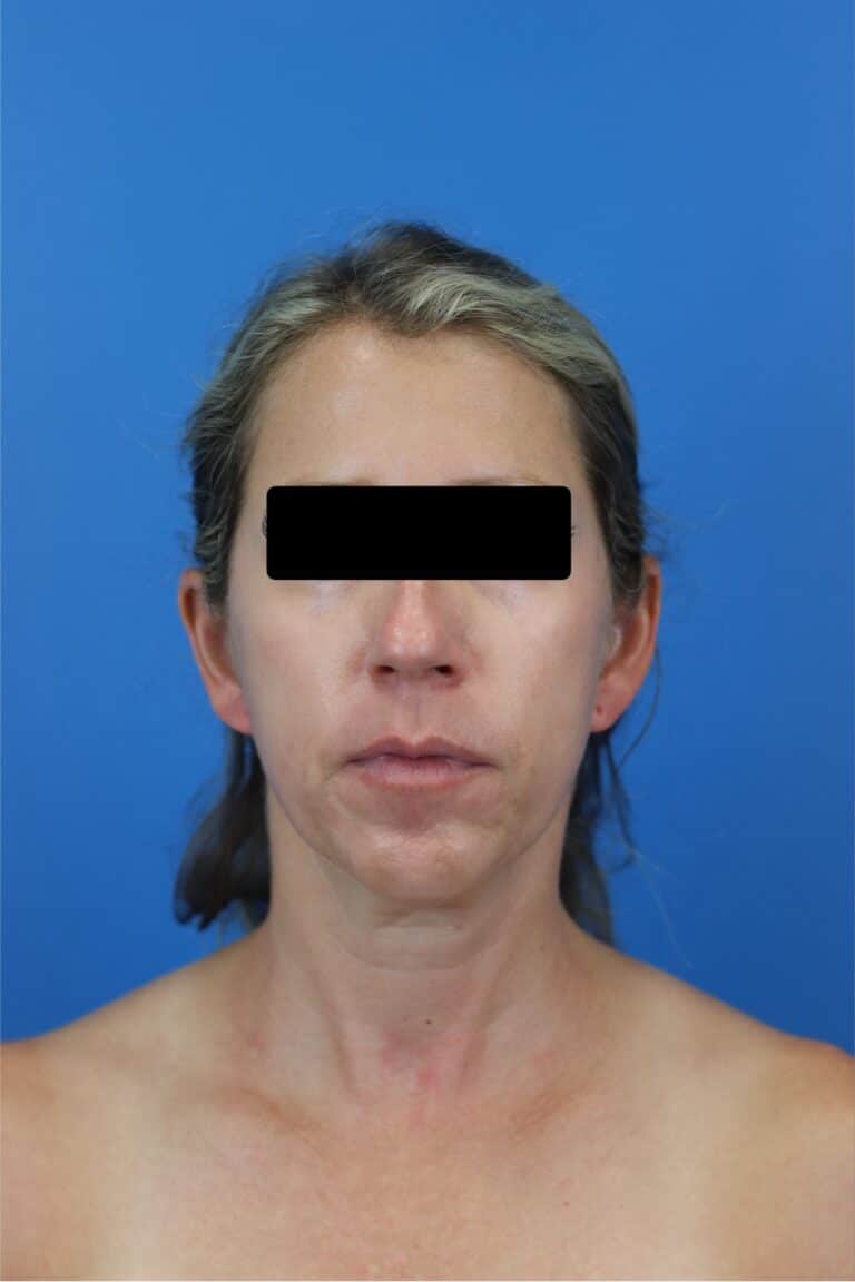 Before Image: FaceTite/NeckTite with Submental Liposuction and Fat Transfer -