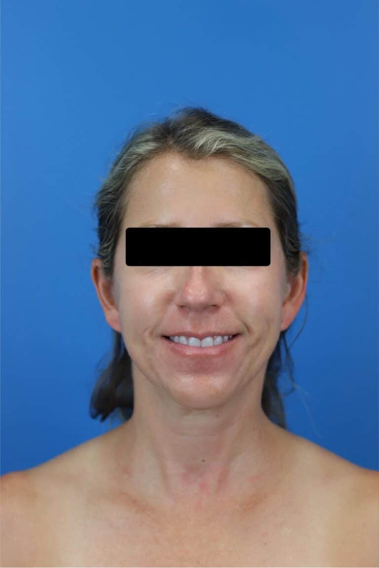 Before Image: FaceTite/NeckTite with Submental Liposuction and Fat Transfer - front