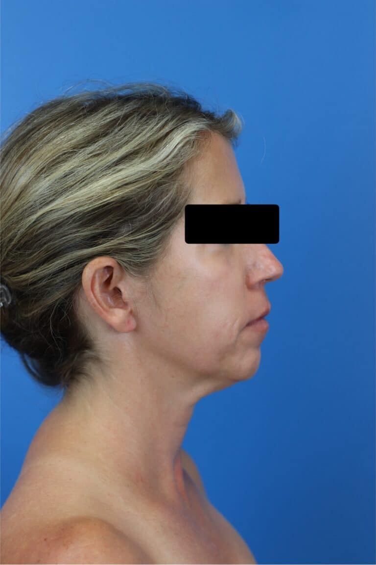 Before Image: FaceTite/NeckTite with Submental Liposuction and Fat Transfer -