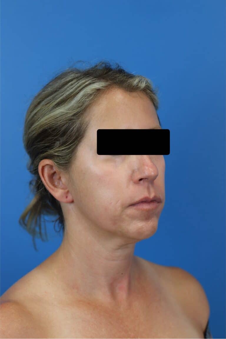 Before Image: FaceTite/NeckTite with Submental Liposuction and Fat Transfer -