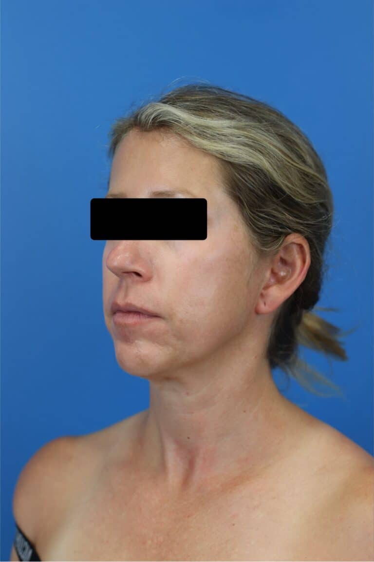 Before Image: FaceTite/NeckTite with Submental Liposuction and Fat Transfer -