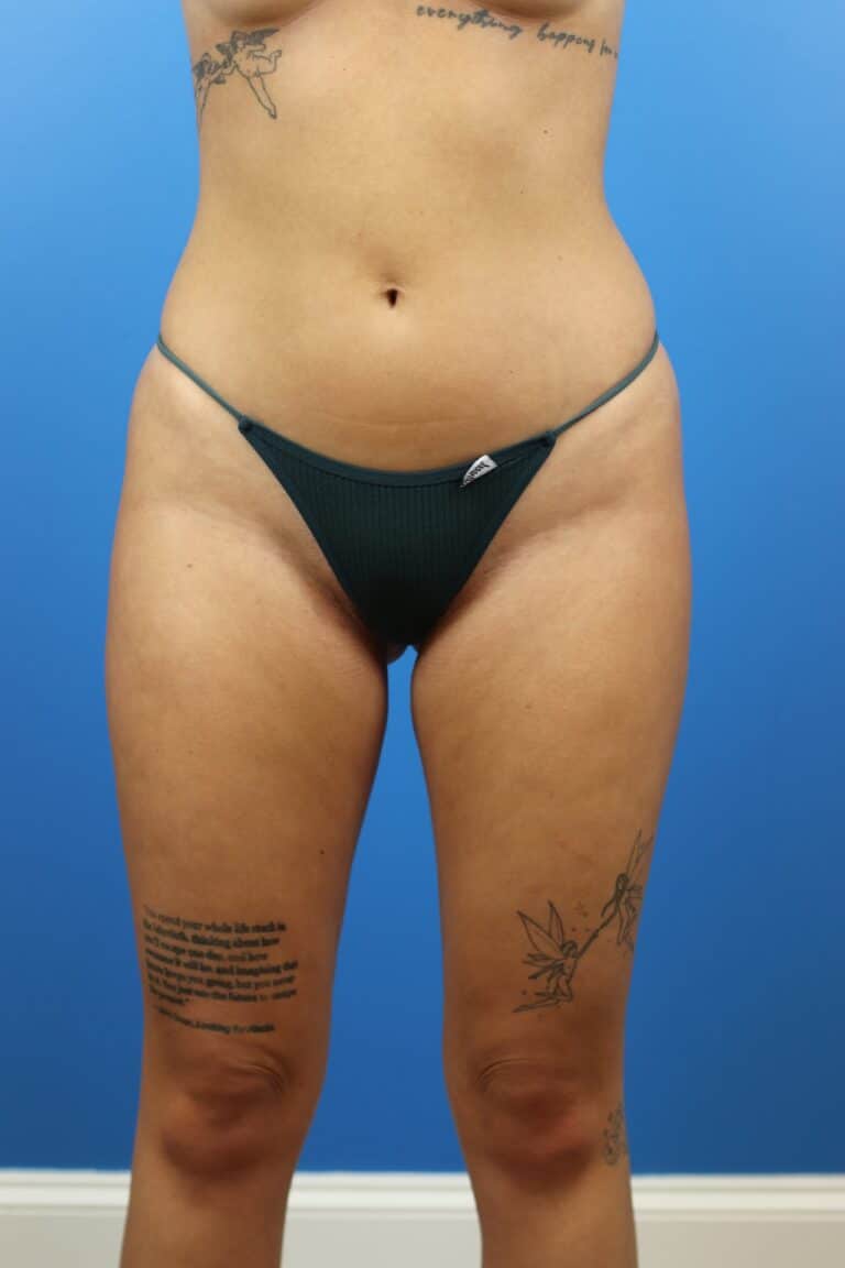 Before Image: Autologous Fat Grafting to Breasts - front