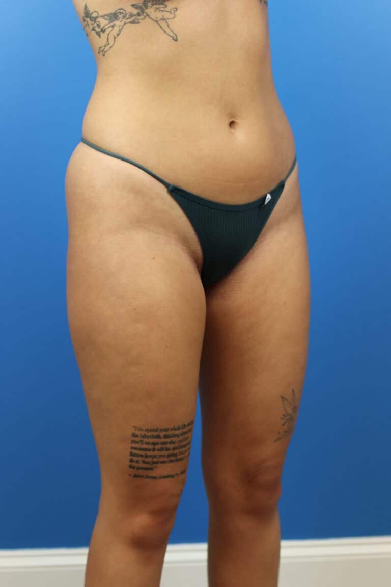 Before Image: Autologous Fat Grafting to Breasts - right-front-oblique