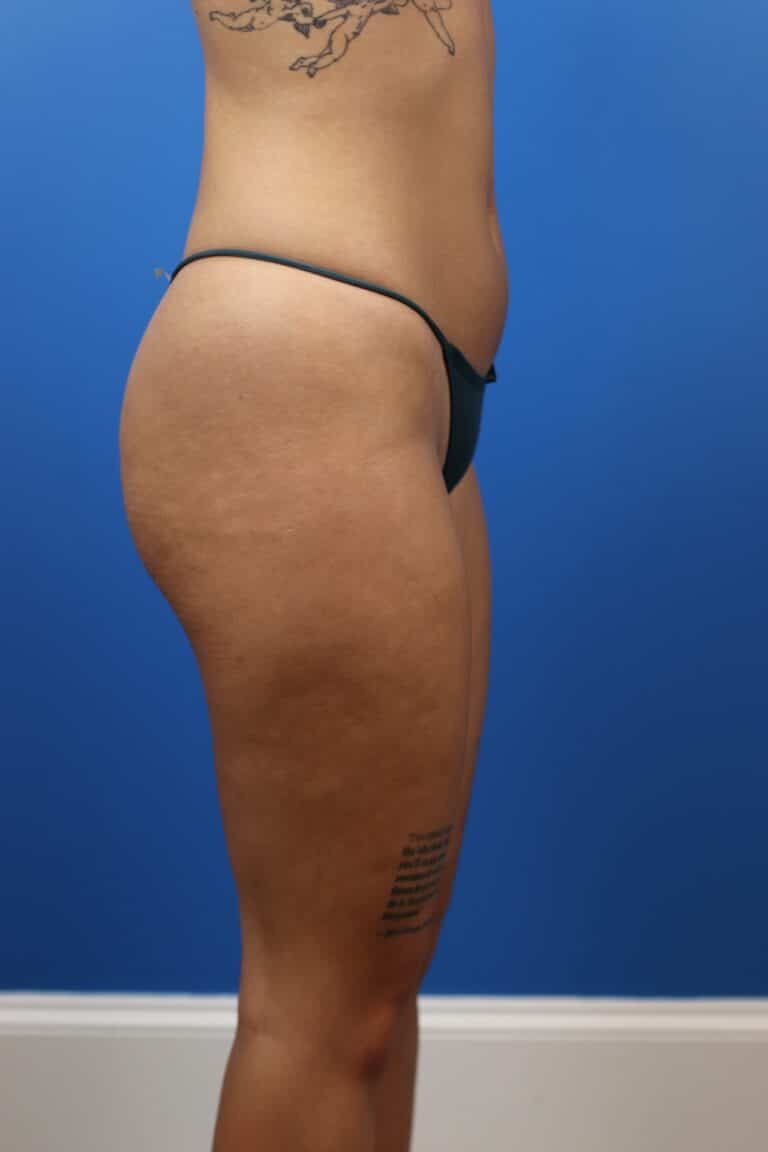 Before Image: Autologous Fat Grafting to Breasts - right-side