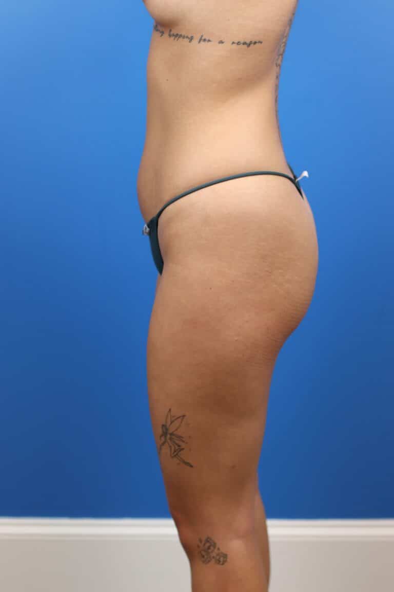 Before Image: Autologous Fat Grafting to Breasts - left-side