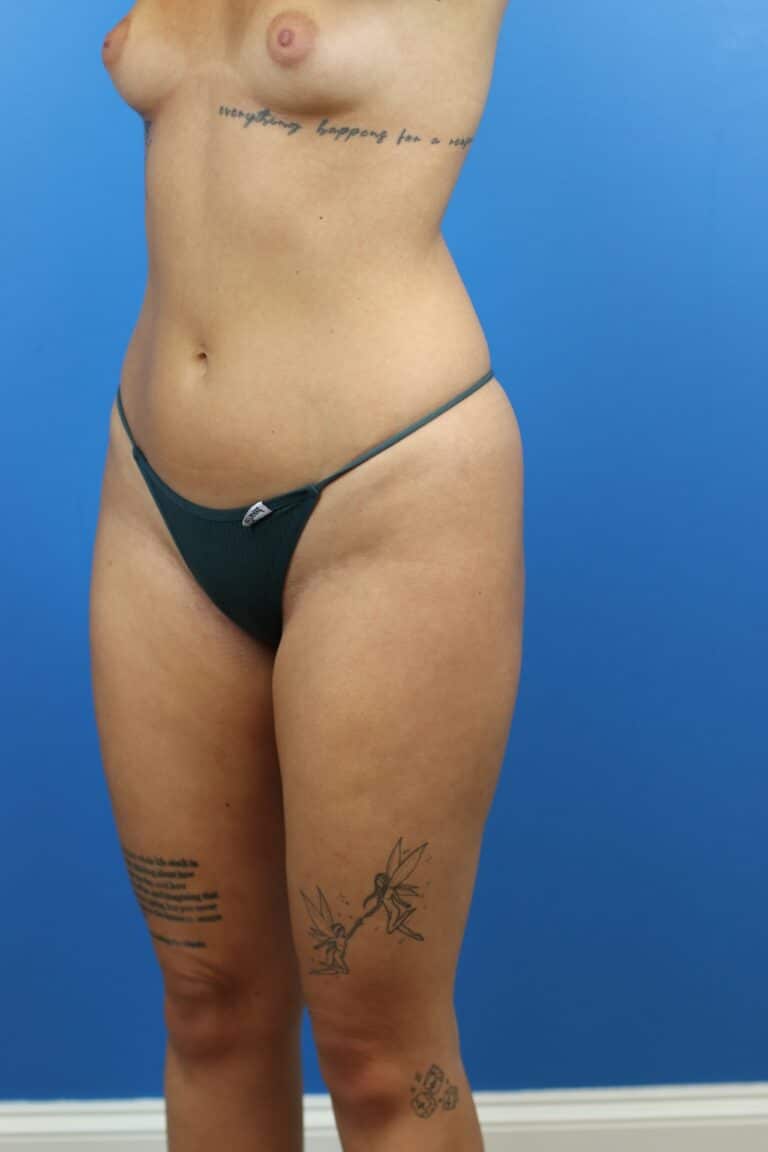 Before Image: Autologous Fat Grafting to Breasts - left-front-oblique
