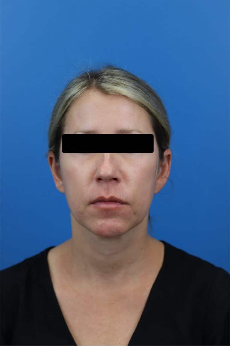 After Image: FaceTite/NeckTite with Submental Liposuction and Fat Transfer -