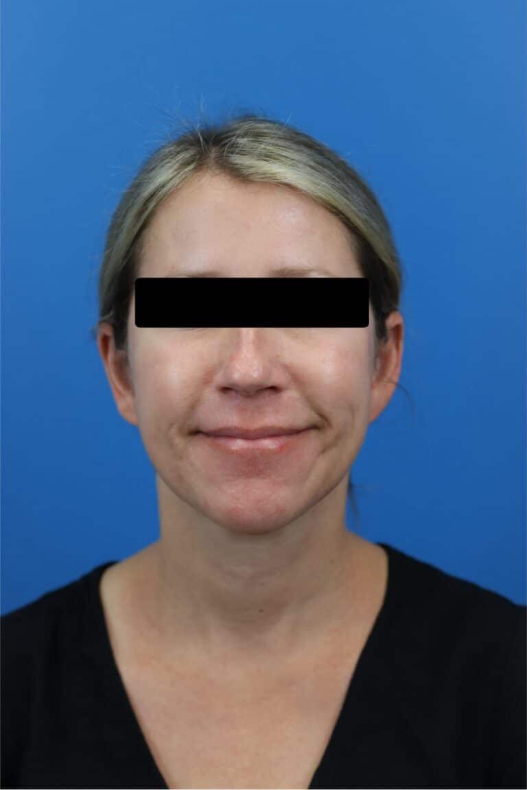 After Image: FaceTite/NeckTite with Submental Liposuction and Fat Transfer - front