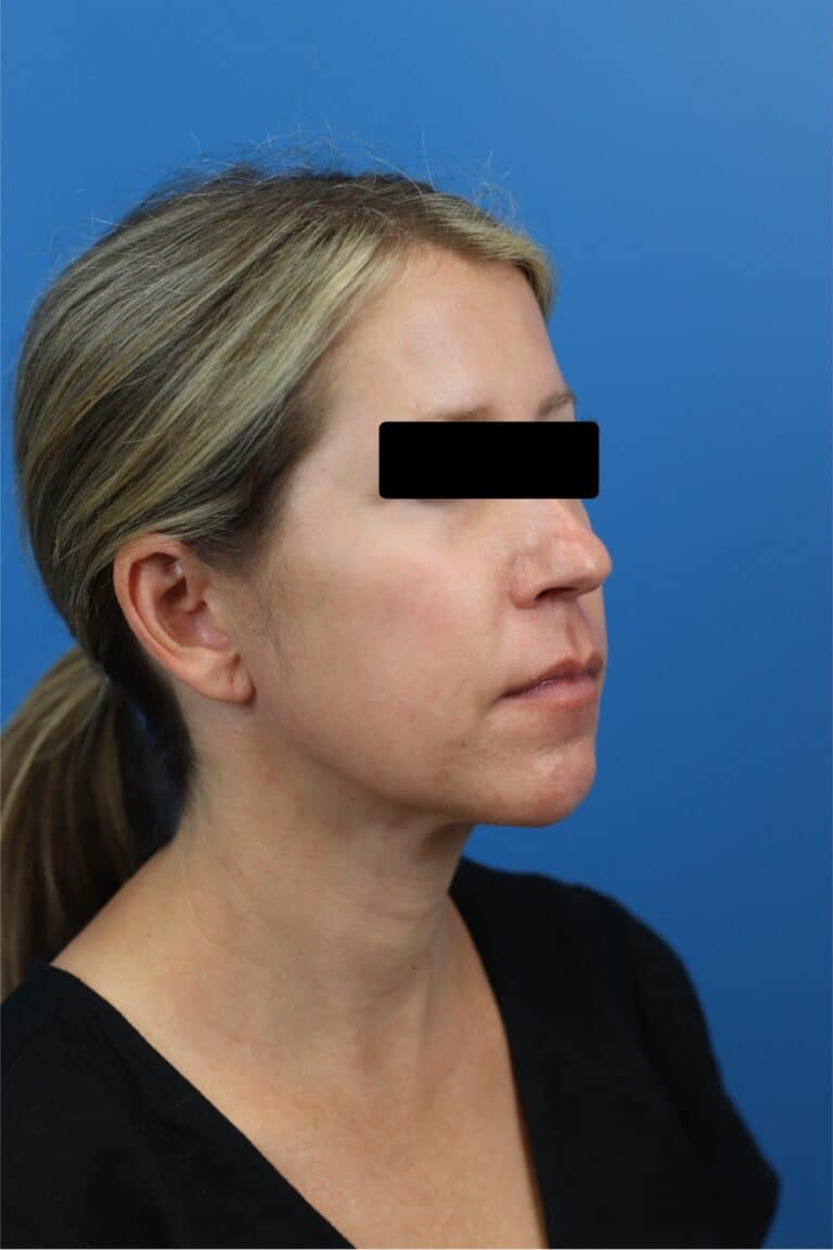 After Image: FaceTite/NeckTite with Submental Liposuction and Fat Transfer -