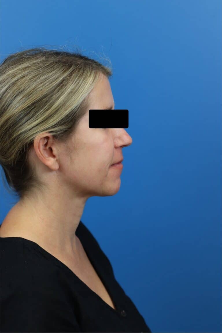 After Image: FaceTite/NeckTite with Submental Liposuction and Fat Transfer -