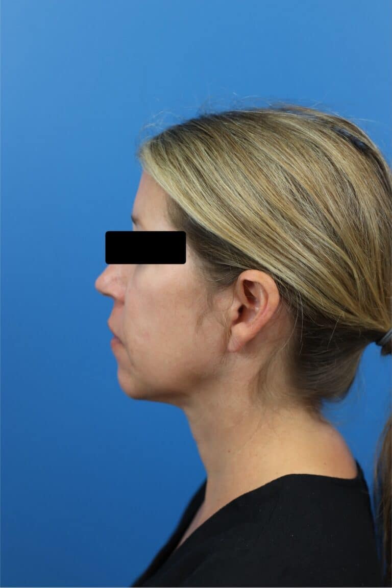 After Image: FaceTite/NeckTite with Submental Liposuction and Fat Transfer -