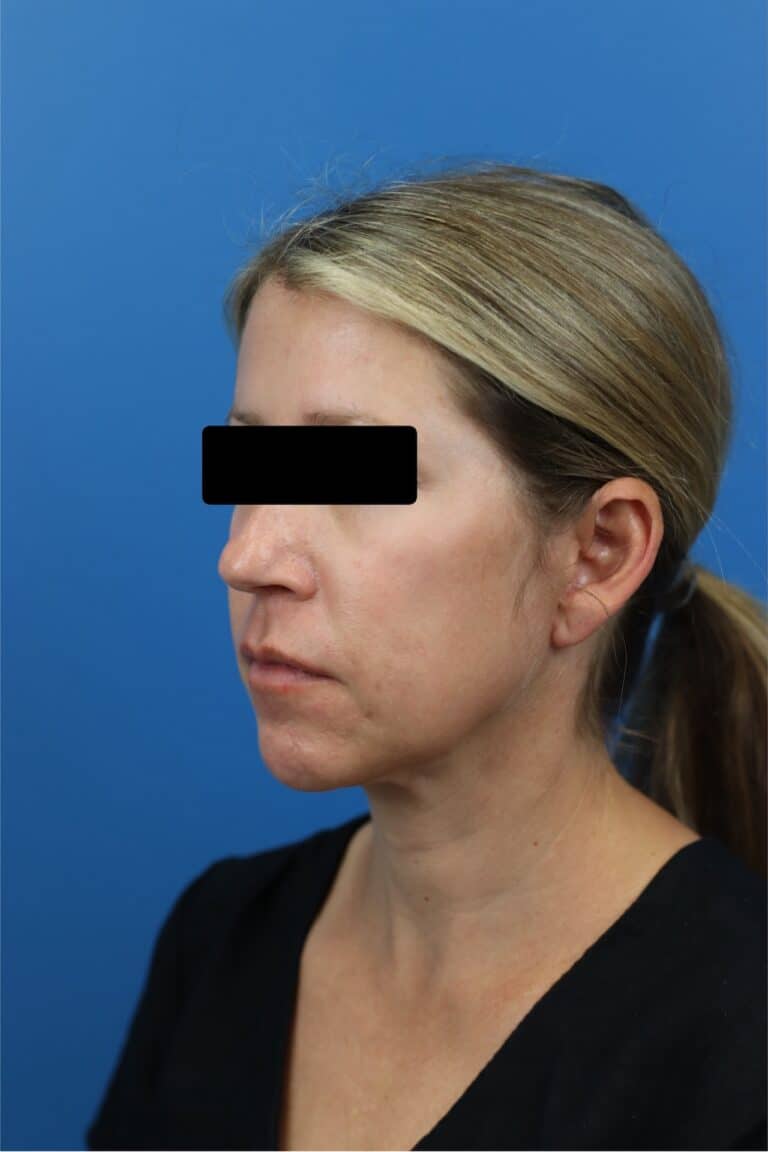 After Image: FaceTite/NeckTite with Submental Liposuction and Fat Transfer -